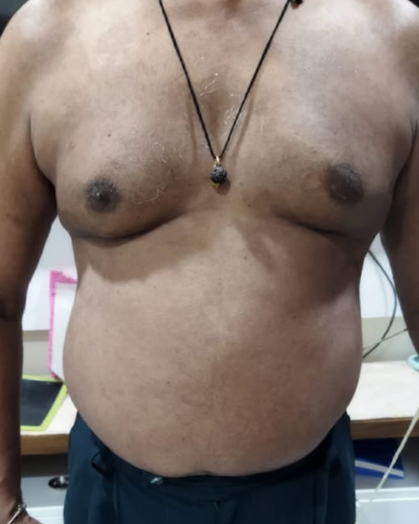 Psoriasis treatment after result